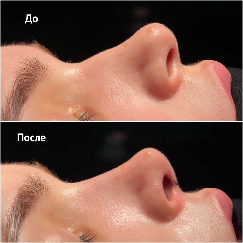 Фото до и после операции риносептопластики