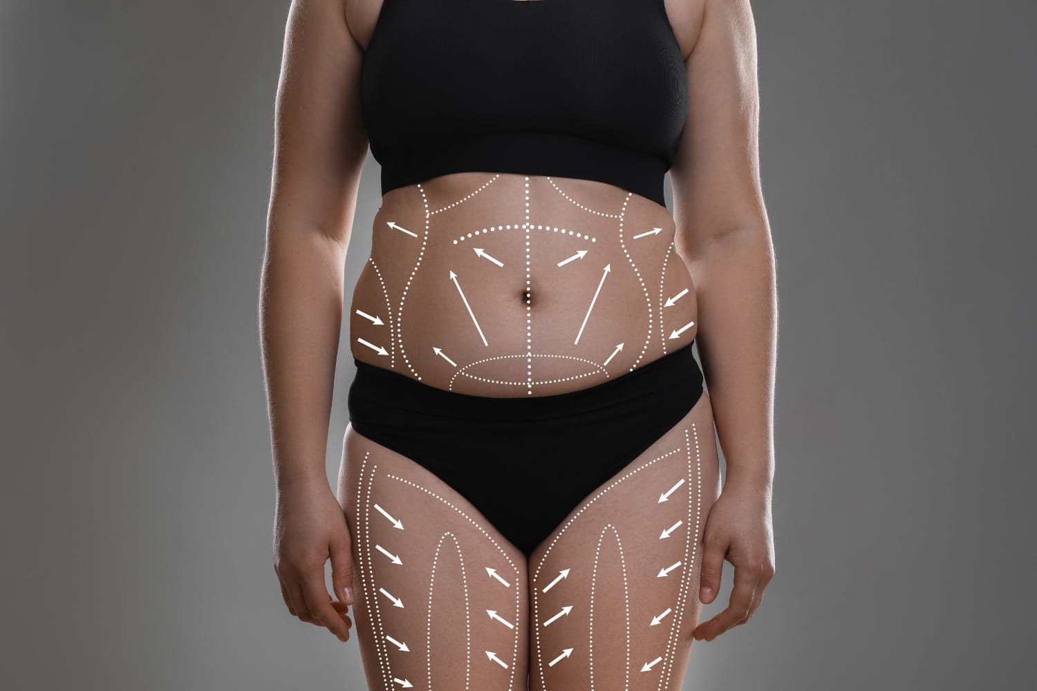 Работа с телом после липосакции: вакуумно-роликовый массаж LPG и спорт