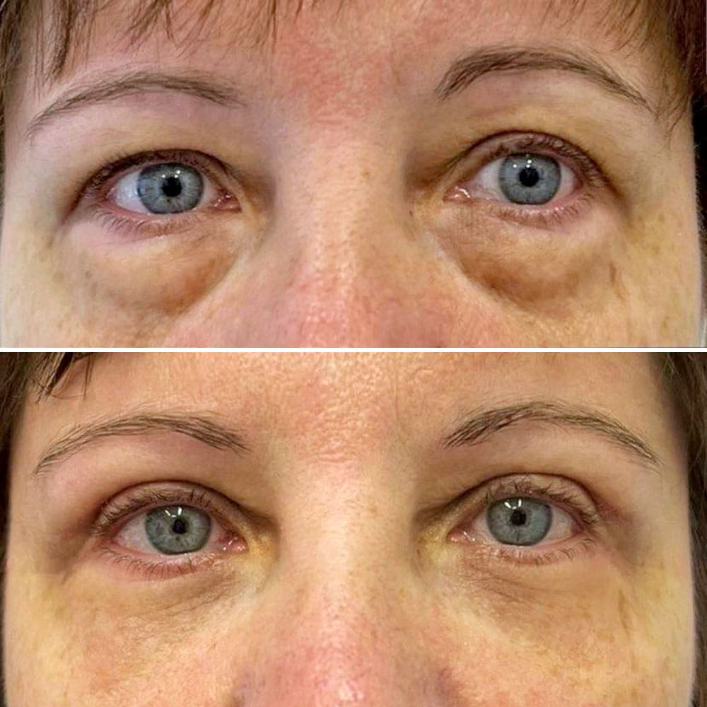 Круговая блефаропластика с миопексией – фото до и после. Пластический хирург ОН КЛИНИК Касумова Рахмат Мурадовна