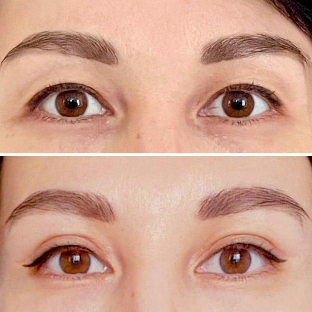 Результат операции по пластике азиатских век – фото до и спустя 2 месяца после операции. Пластический хирург ОН КЛИНИК Касумова Рахмат Мурадовна