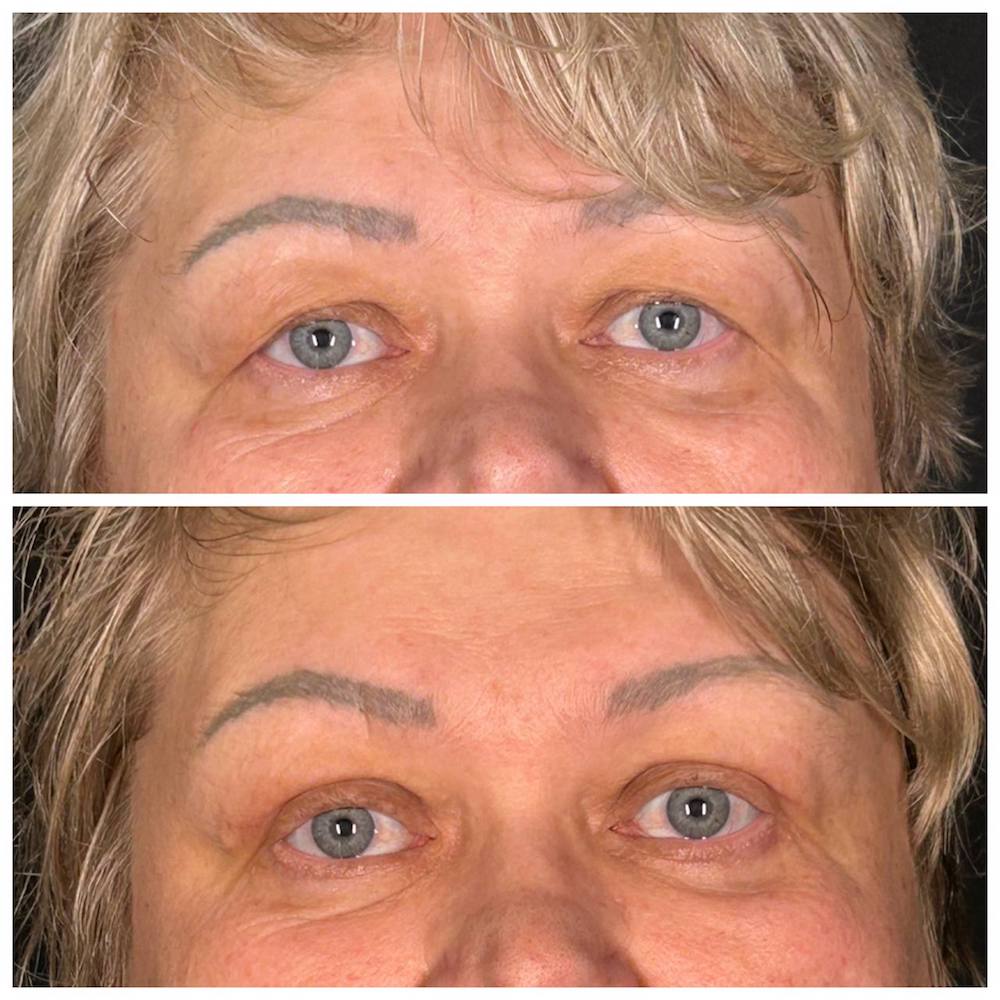 Верхняя блефаропластика: фото до и после операции. Пластический хирург ОН КЛИНИК Тарасов Максим Дмитриевич