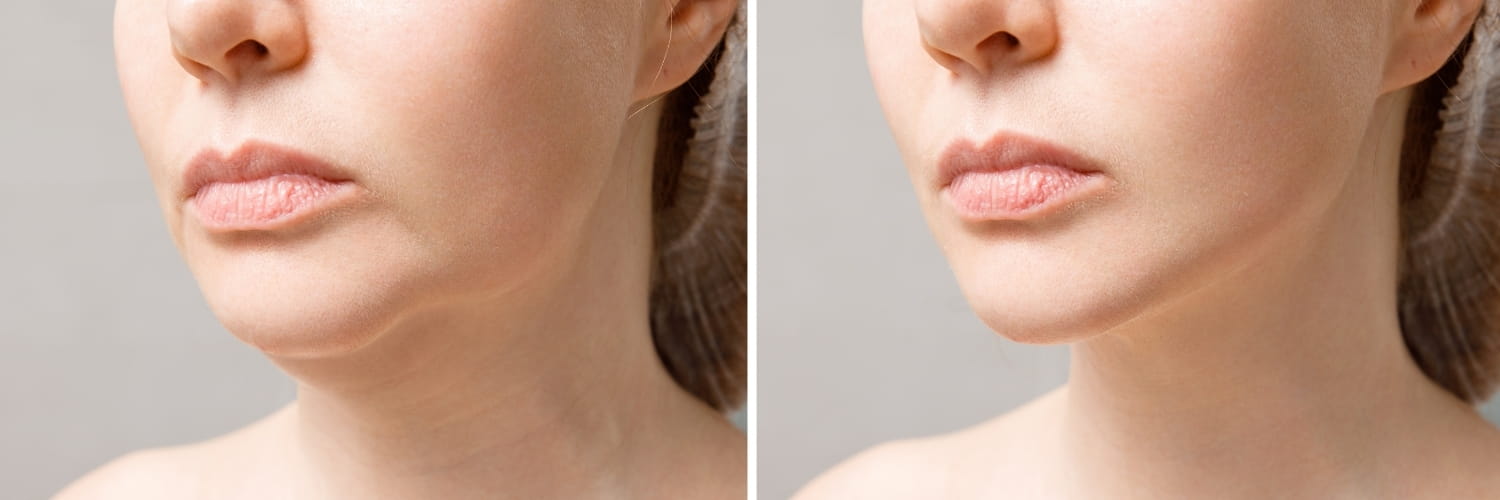 Композитный SMAS-лифтинг лица: глубинное омоложение в Москве