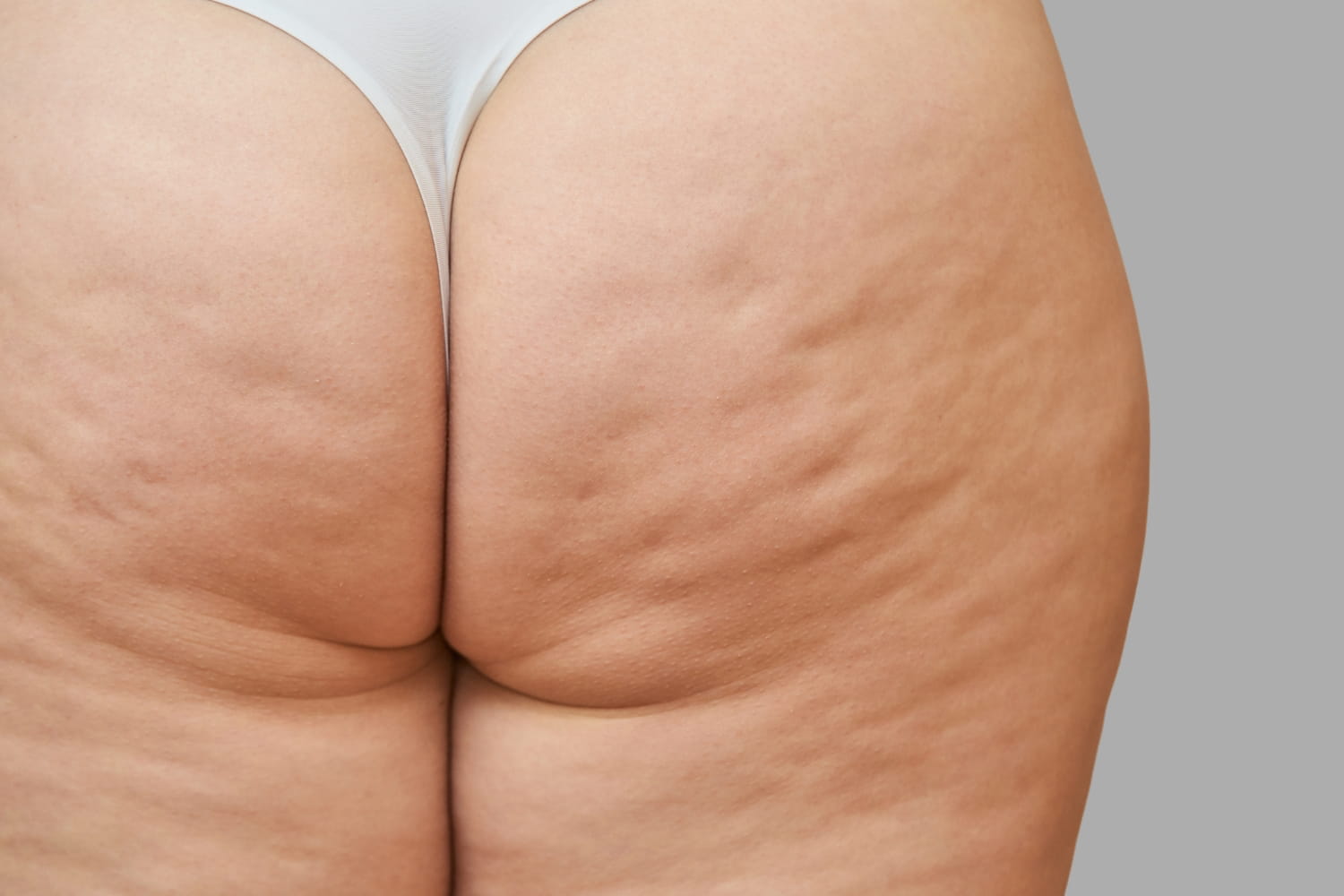 Как избавиться от целлюлита на ногах и ягодицах Как избавиться от целлюлита на ногах и ягодицах