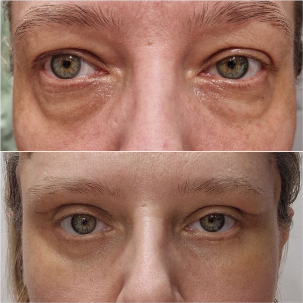 Результат операции – круговая блефаропластика с фиксацией бровей. Пластический хирург ОН КЛИНИК Зиятдинов Халиль Камилевич