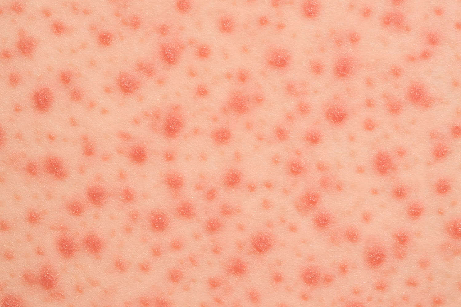 Высыпания на коже