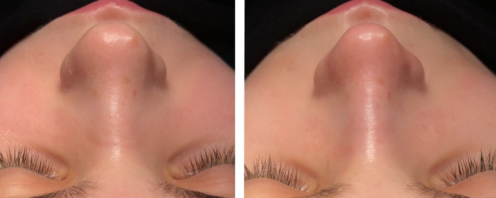 Фото до и после операции риносептопластики Фото до и после операции риносептопластики
