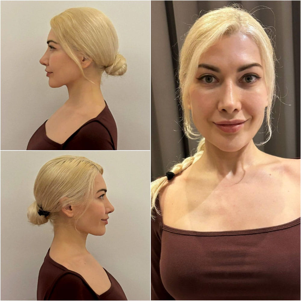 Результат ринопластики – фото спустя 6 месяцев после операции