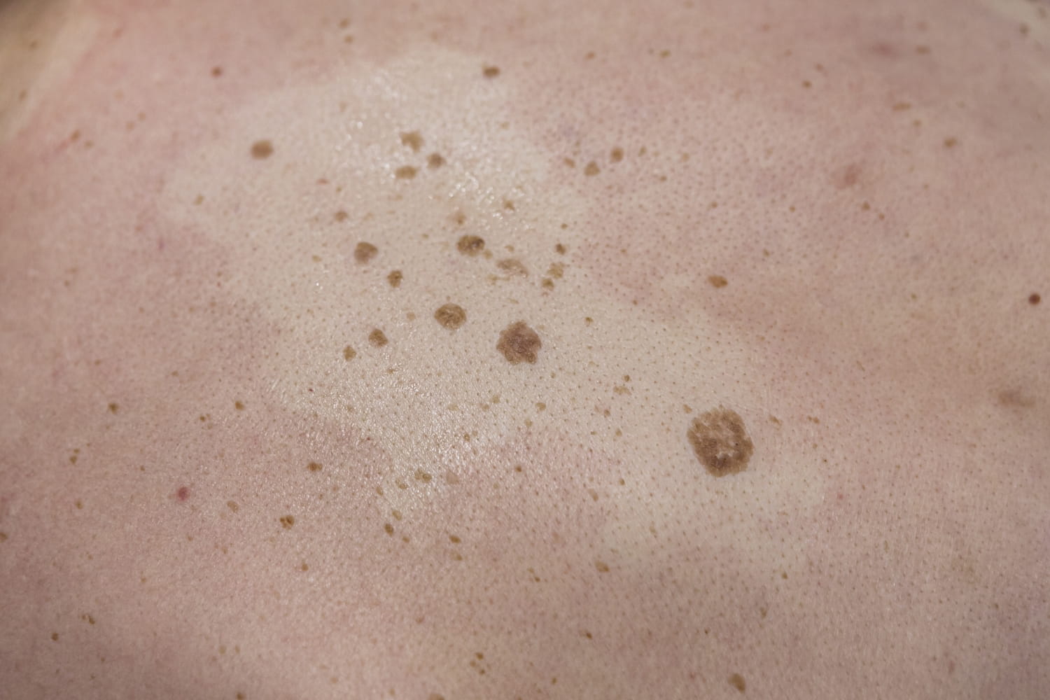 Симптомы кератоза