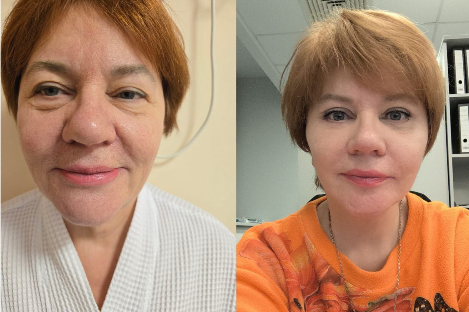 Композитный СМАС-лифтинг: результат преображения. Пластический хирург Зиятдинов Х.К.