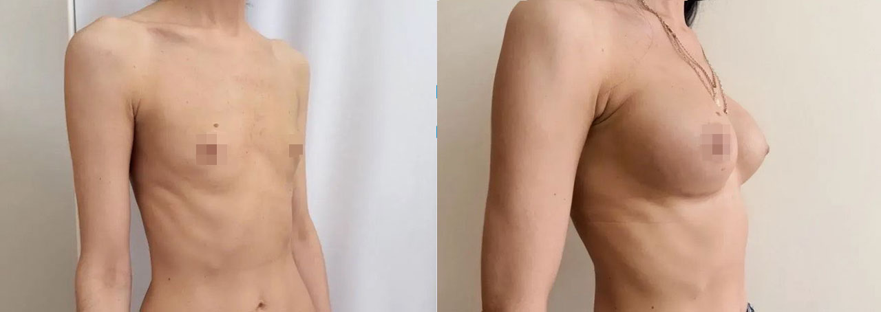Результат операции по увеличению груди – фото до и спустя 7 месяцев после операции.
