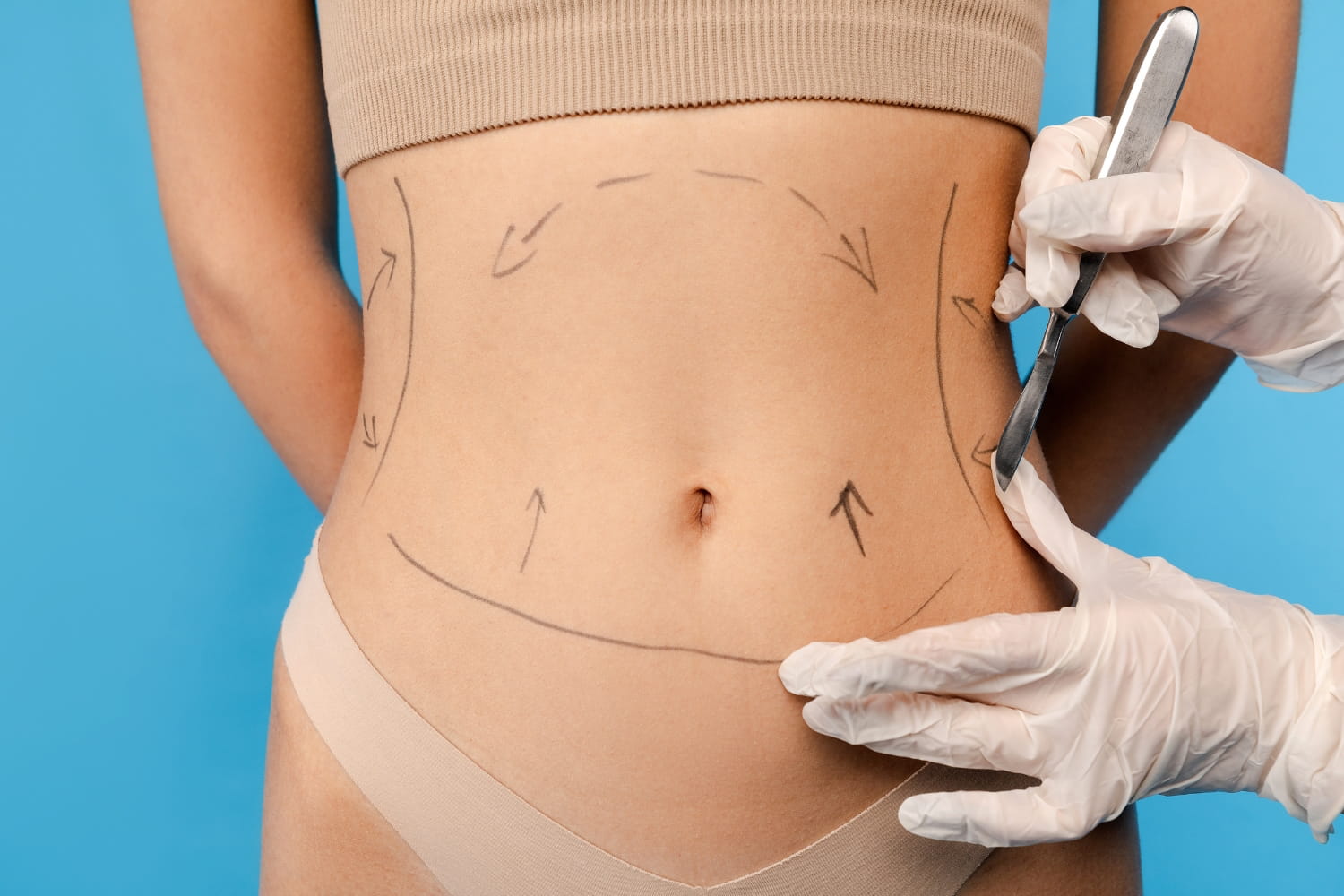 Сужение талии без удаления ребер