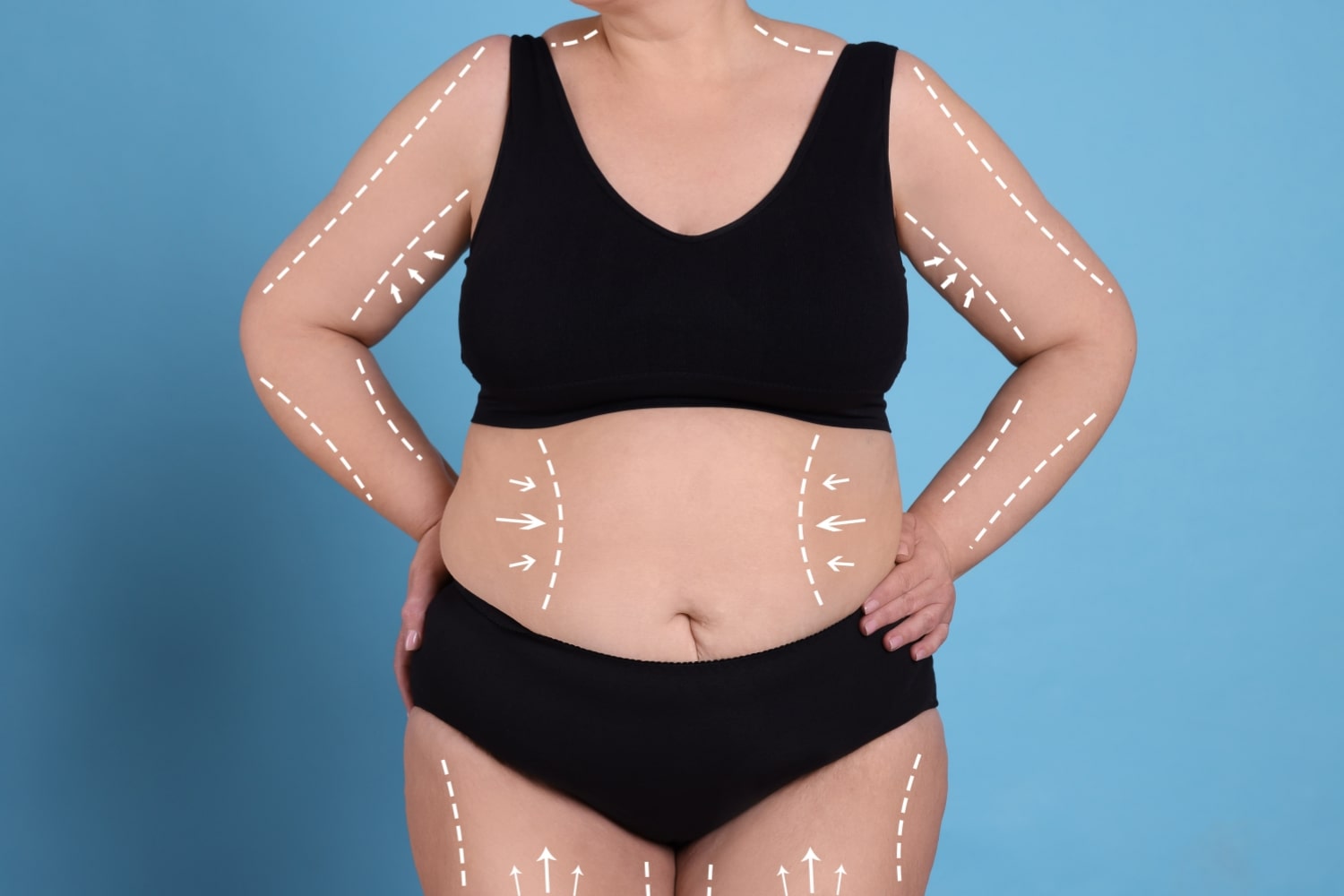 Липомоделирование тела