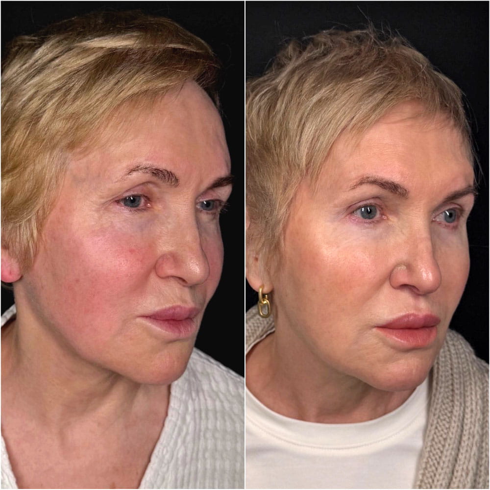 Круговая блефаропластика – фото до и после операции. Пластический хирург ОН КЛИНИК Семенова Юлия Игоревна