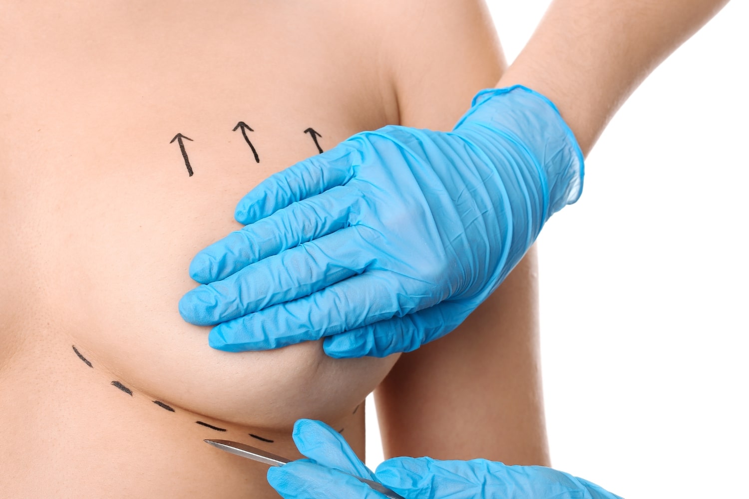 Якорная подтяжка груди Якорная подтяжка груди