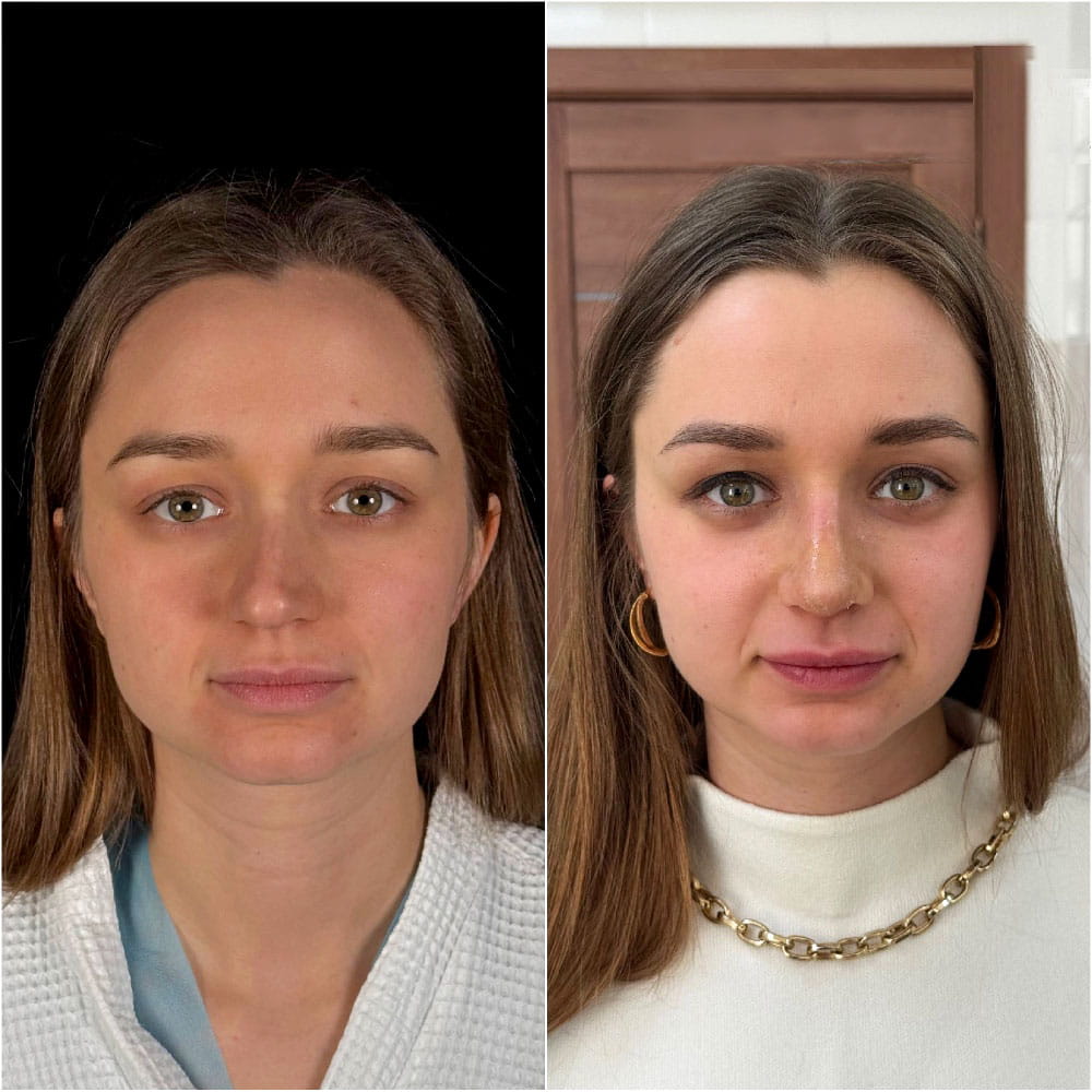 Риносептопластика. Пластический хирург Ким Д.С. Фото до и после операции