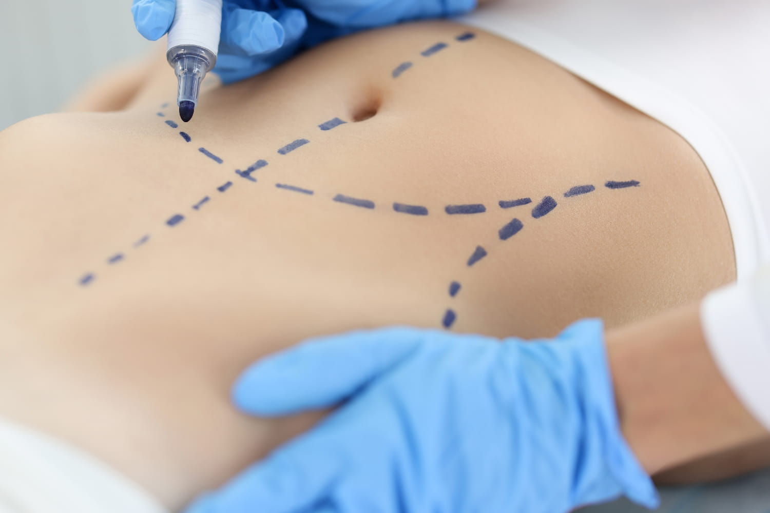 Липоскульптурирование живота - моделирование контуров тела путем пересадки собственной жировой ткани