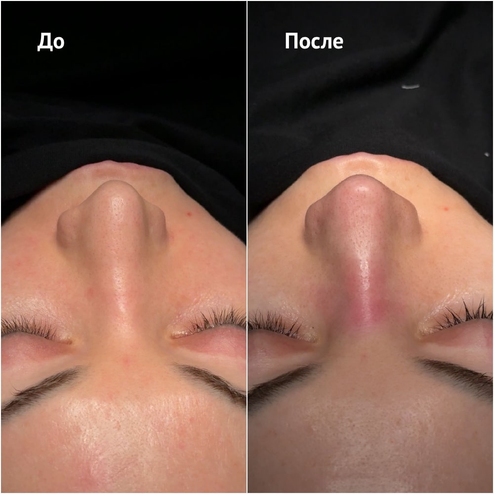 Фото до и после операции риносептопластики