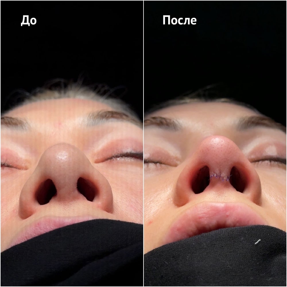 Фото до и после операции риносептопластики