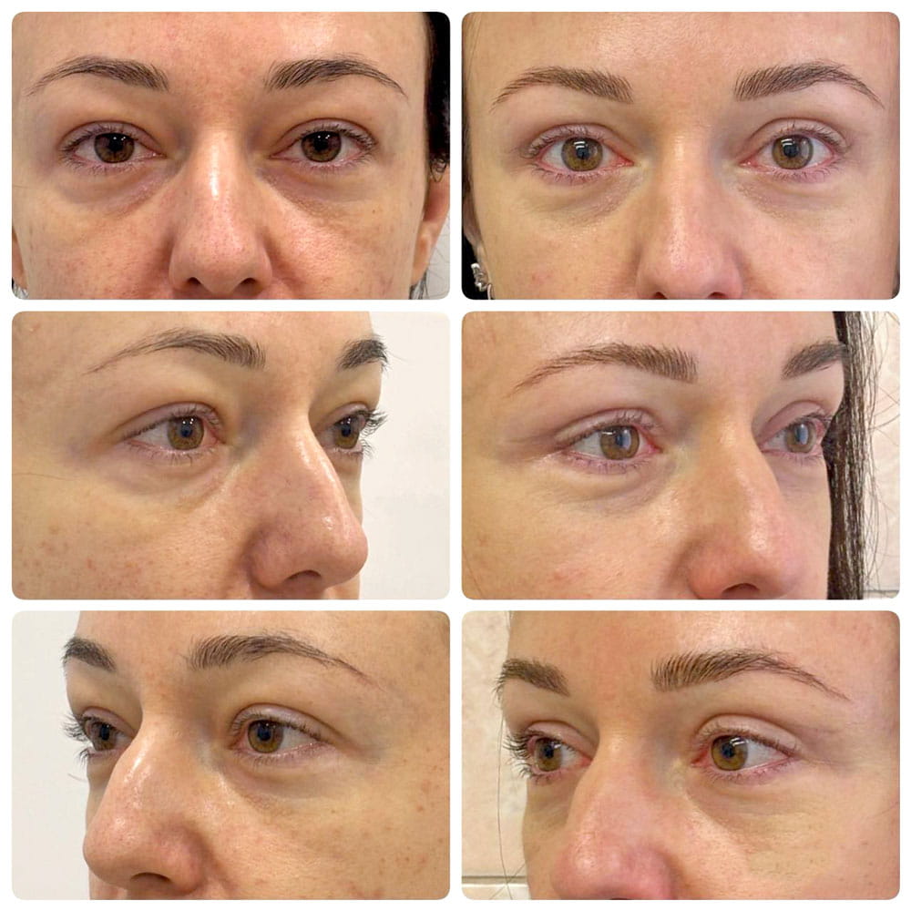 Результат операции по коррекции верхних век – фото до и после. Пластический хирург ОН КЛИНИК Еременко Валерий Сергеевич