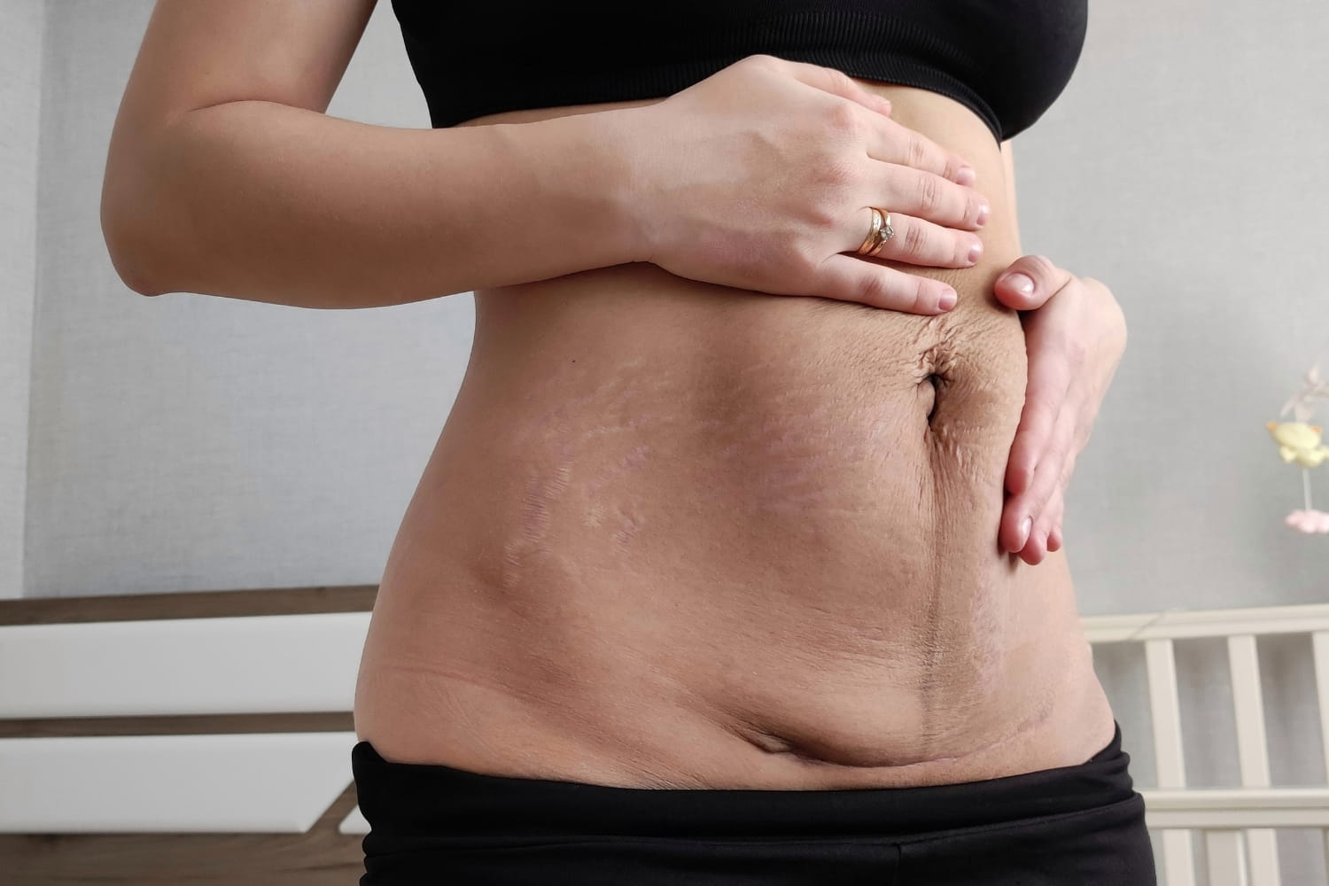 Лишняя кожа после похудения и родов