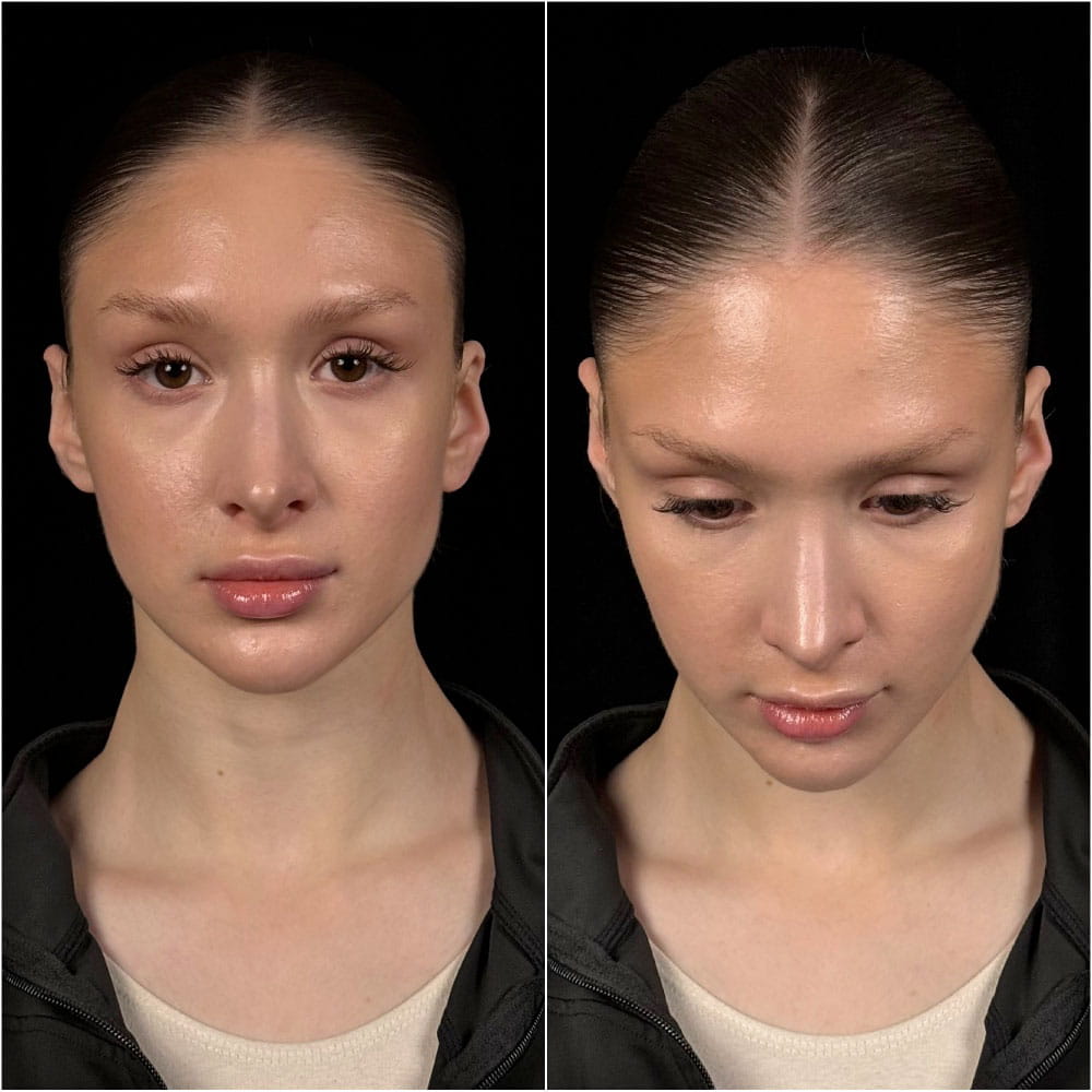 Сохраняющая ринопластика – результат через 6 месяцев после операции