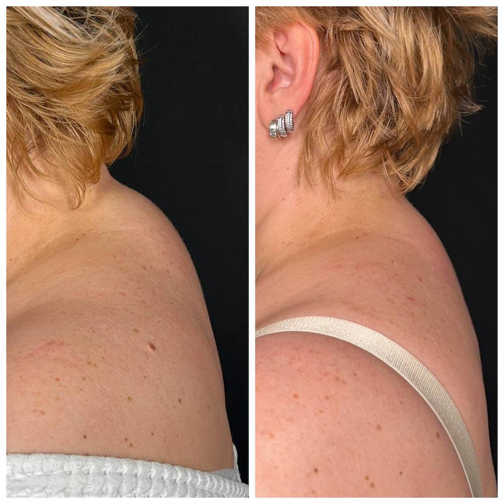 Липосакция холки: результат операции. Пластический хирург ОН КЛИНИК Тарасов Максим Дмитриевич
