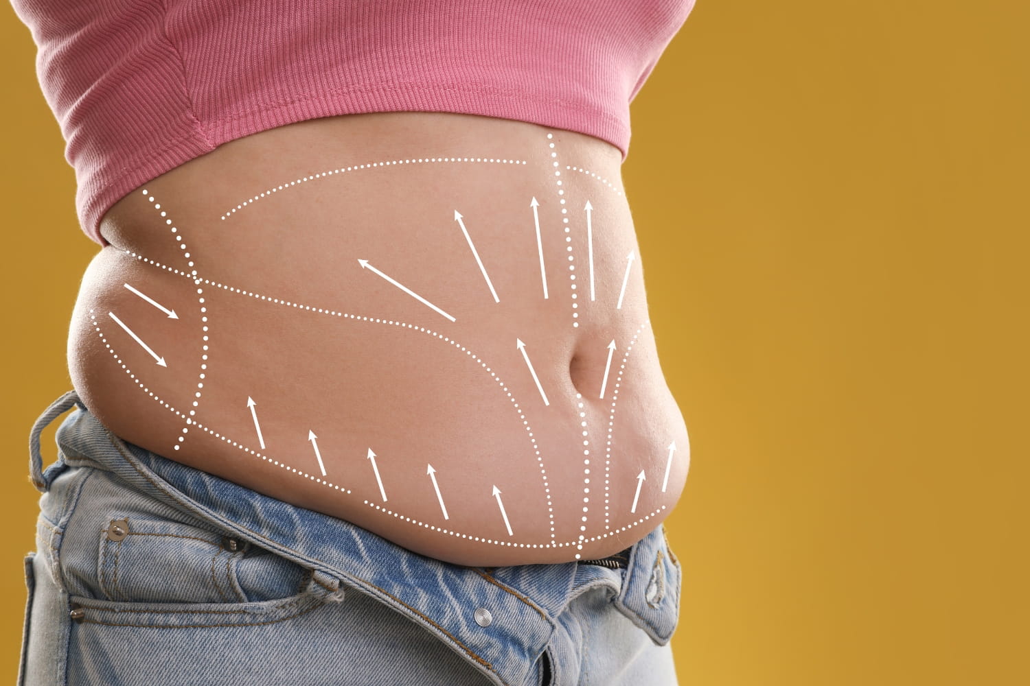 Липосакция 360° (комплексная операция: живот, бока, спина)