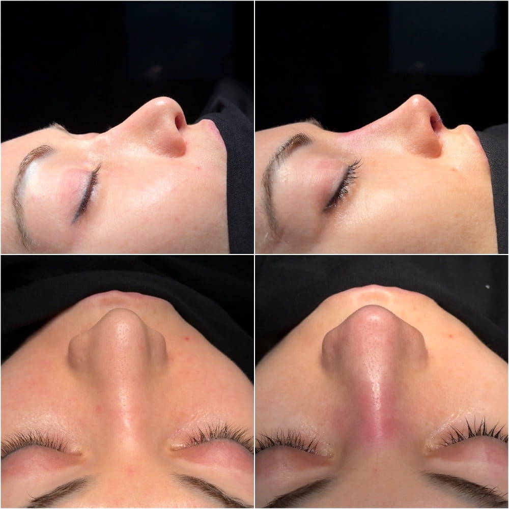 Результат ринопластики – фото до и после операции