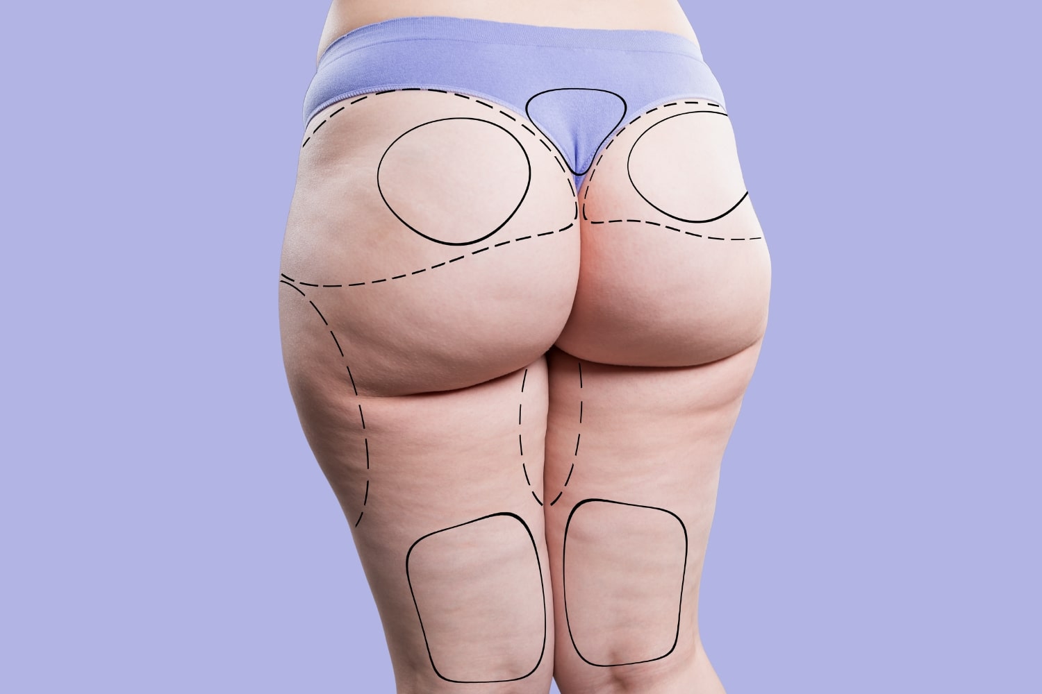 Этапы липомоделирования тела