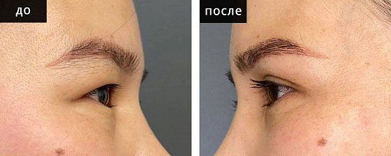 Блефаропластика азиатских глаз. Болотбекова 04: до и после – фото 3