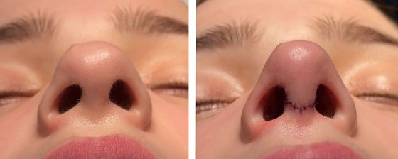 Ринопластика. Ким Денис Сонхаевич 02: до и после – фото 23