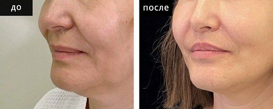 Пластика губ. Зварич 01: до и после – фото 9