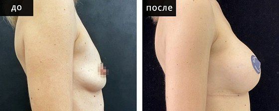 Маммопластика аугментационная. Зварич 03: до и после – фото 26