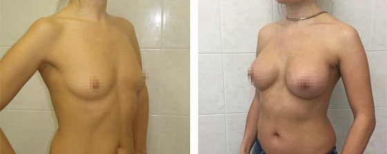 Маммопластика. Еременко В.С._22: до и после – фото 49