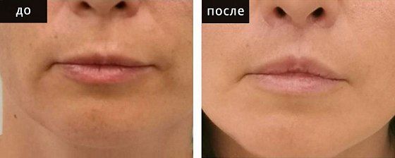 Пластика губ. Глебова 01: до и после – фото 6