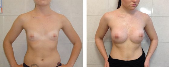 Маммопластика. Еременко В.С._25: до и после – фото 23