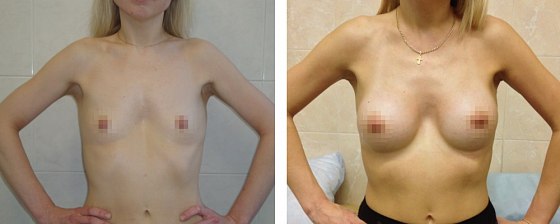 Маммопластика. Еременко В.С._27: до и после – фото 54