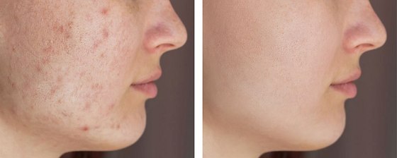 Плазмолифтинг кожи лица: до и после – фото 2