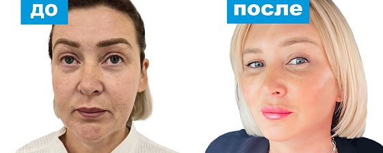 Эндоскопическая подтяжка височной зоны лица. Зиятдинов 02: до и после – фото 4