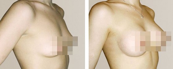 Маммопластика: до и после – фото 42