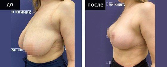 Подтяжка груди. Мурзаева 27: до и после – фото 17