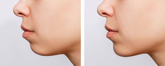 Ментопластика 01: до и после – фото 1