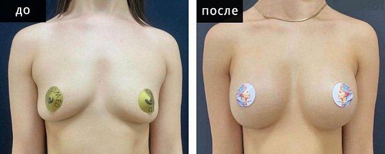 Маммопластика: до и после – фото 5
