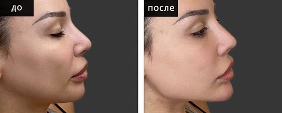 Контурная пластика овала лица: до и после – фото 5