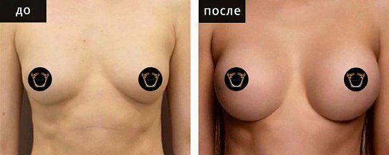 Маммопластика аугментационная. Гусляков 10: до и после – фото 18
