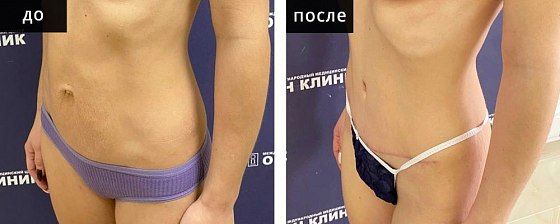 Абдоминопластика (удаление диастаза прямых мышц живота). Мурзаева 05: до и после – фото 3