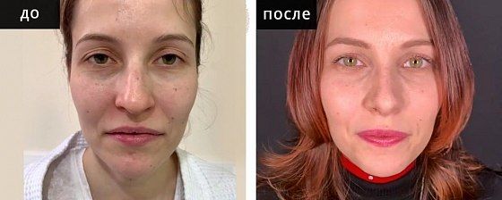 Ринопластика: до и после – фото 20