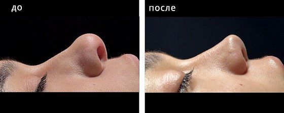 Ринопластика: до и после – фото 38