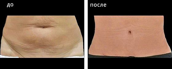Абдоминопластика. Гусляков 01: до и после – фото 7