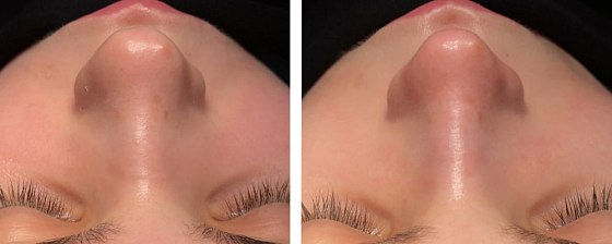 Ринопластика. Ким Денис Сонхаевич 03: до и после – фото 24